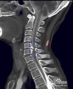 颈椎骨质增生 颈椎骨质增生 颈椎骨质增生-概述，颈椎骨质增生-临床实践