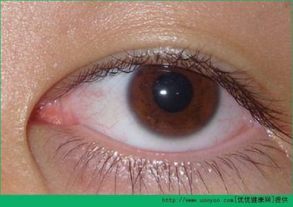 眼睛有红血丝怎么消除 眼睛有血丝怎么办？
