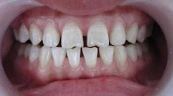 牙齿稀疏怎么办 牙齿稀疏 牙齿稀疏-定义，牙齿稀疏-类型
