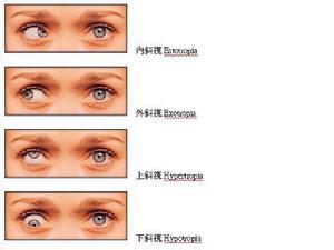 麻痹性斜视的症状 什么是麻痹性斜视