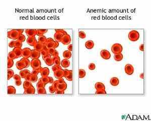 anemia名词解释 anemia