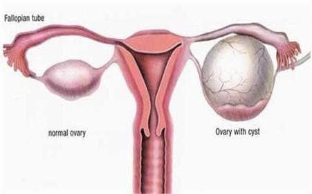 性疾病预防与治疗 输卵管癌 输卵管癌-疾病概述，输卵管癌-治疗和预防