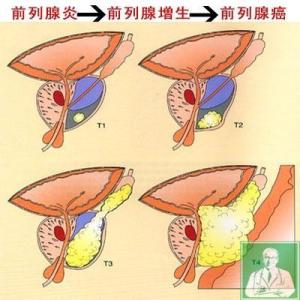 女性尿频尿痛吃什么药 女性尿频尿痛是什么原因