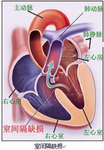 先天性心血管畸形 心血管 心血管-简介，心血管-什么是先天性心脏病