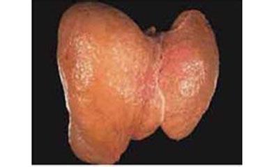 肝脓肿和肝癌的鉴别 肝脓肿 肝脓肿-概述，肝脓肿-与肝癌鉴别