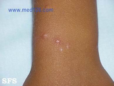 结节性痒疹的症状 痒疹 痒疹-病因，痒疹-症状