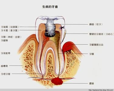 一次性根管治疗适应症 口腔根管治疗 口腔根管治疗-定义，口腔根管治疗-适应症