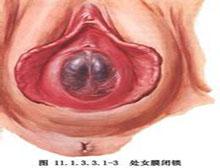 宫颈癌的早期症状 宫血症 宫血症-概述，宫血症-症状