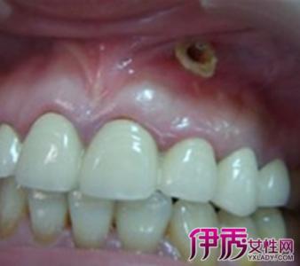 肛周脓肿的预防方法 牙槽脓肿 牙槽脓肿-概述，牙槽脓肿-预防保健