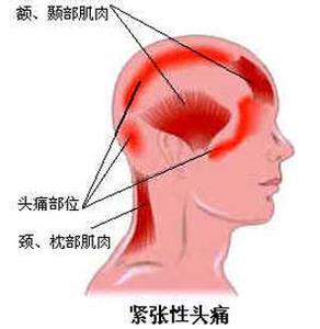 亚临床甲减的病因 肌紧张性头痛 肌紧张性头痛-病因，肌紧张性头痛-临床表现