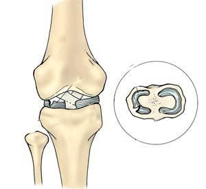 膝关节腔穿刺的适应证 膝关节镜 膝关节镜-适应人群，膝关节镜-术前准备