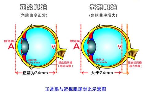 激光治疗近视的危害 近视 近视-简介，近视-原理和危害