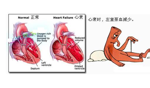 心力衰竭的临床表现 心力衰竭 心力衰竭-简介，心力衰竭-临床分型