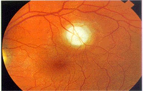 电光性眼炎 电光性眼炎 电光性眼炎-概述，电光性眼炎-病因病理