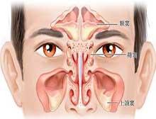 额窦炎症状及治疗方法 额窦炎症状表现有哪些