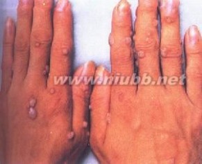 传染性软疣和尖锐湿疣 疣 疣-疾病描述，疣-传染性软疣