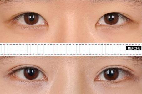 埋线双眼皮的副作用 埋线双眼皮副作用到底有没有