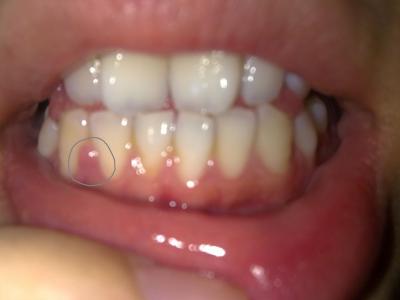 牙龈脓肿一直不消 牙龈脓肿怎么回事