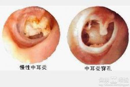 中耳炎会自愈吗 急性中耳炎的症状表现