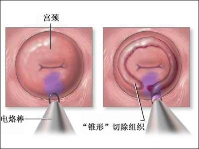 宫颈囊肿用什么药最好 宫颈囊肿吃什么药