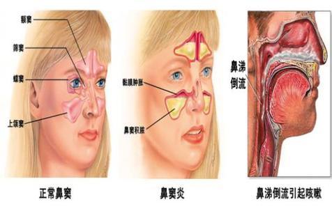 急性鼻炎症状 急性鼻炎的典型症状