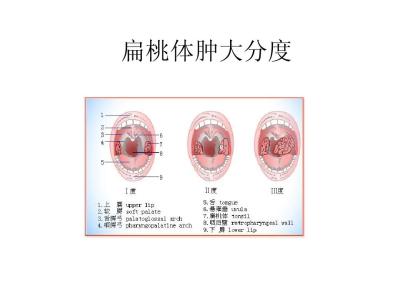 甲状腺肿大分度 甲状腺肿大怎么分度