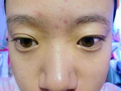 鹿茸的功效与作用 眉毛中间长痘痘是什么原因?