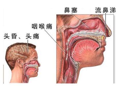 鼻炎吃什么药效果最好 慢性鼻炎的最佳治疗方法