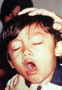 百日咳恢复期的表现 百日咳 百日咳-概述，百日咳-临床表现