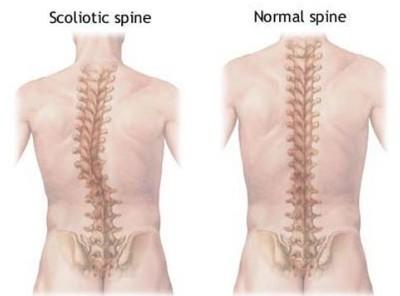 病理学的概述 脊柱侧凸 脊柱侧凸-病理概述，脊柱侧凸-病理原因