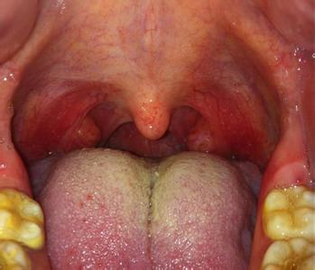 治疗咽喉炎有哪些方法 咽炎的有哪些治疗方法？