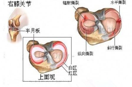 半月板损伤怎么治疗 半月板损伤的治疗方法