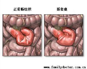 肠梗阻的饮食三宜三忌 肠梗阻是怎么引起的