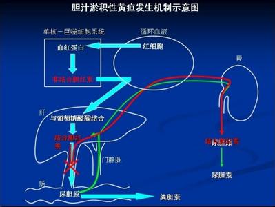 溶血性黄疸的病因 黄疸如何治疗 黄疸的5大病因