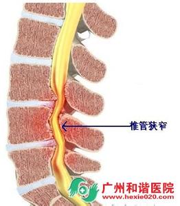 椎管狭窄的锻炼方法 椎管狭窄的治疗方法