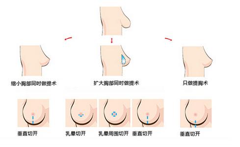 治疗乳房下垂的方法 乳房下垂 乳房下垂-治疗方法