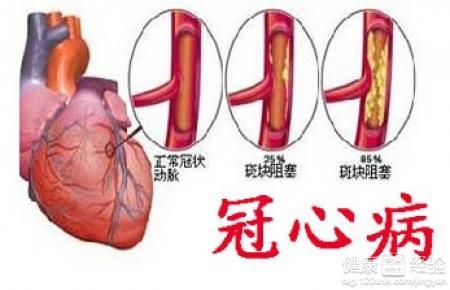 冠心病的初期症状 冠心病的前期症状