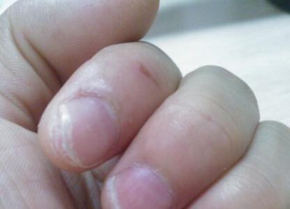 治疗灰指甲土方法 灰指甲的治疗土方法 6个土方法治疗灰指甲