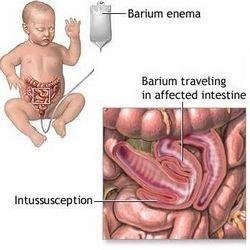 小儿多动症发病原因 小儿肠套叠 小儿肠套叠-简介，小儿肠套叠-发病原因