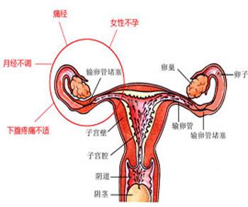 治疗输卵管堵塞的方法 输卵管堵塞怎么治 输卵管治疗方法