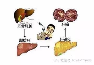 脂肪肝的症状有哪些 脂肪肝症状 从舌头变化分辨脂肪肝