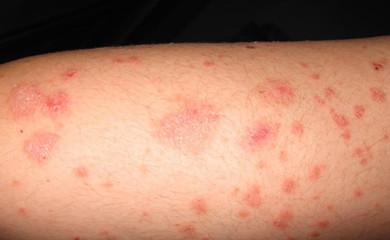 过敏性皮炎湿疹吃什么 过敏性皮炎湿疹 什么是过敏性皮炎湿疹