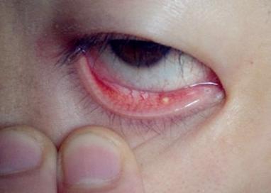 沙眼用什么眼药水 沙眼的症状