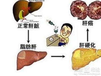 脂肪肝及肝脏硬度检查 预防脂肪肝吃什么 5种茶喝出健康肝脏