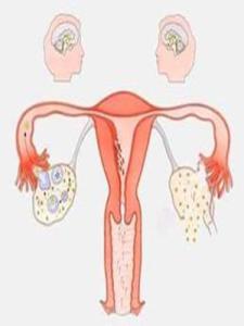 输卵管造影片子解释图 输卵管通液 输卵管通液-输卵管通液术概念解释，输卵管通液-输卵