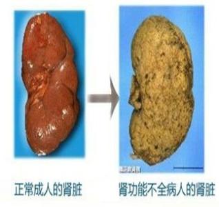 肾功能不全的症状 肾功能不全的症状 肾功能如何饮食