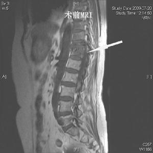 脊柱结核的症状 什么是脊柱结核 脊柱结核的症状与治疗