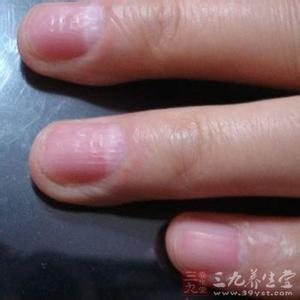 指甲凹陷是怎么回事 指甲凹陷 指甲凹陷如何预防（3）