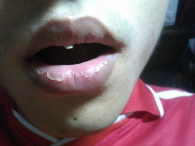唇炎是什么样子的 唇炎的症状是什么