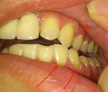 预防牙结石 牙石是什么 如何有效预防以及治疗牙石（7）
